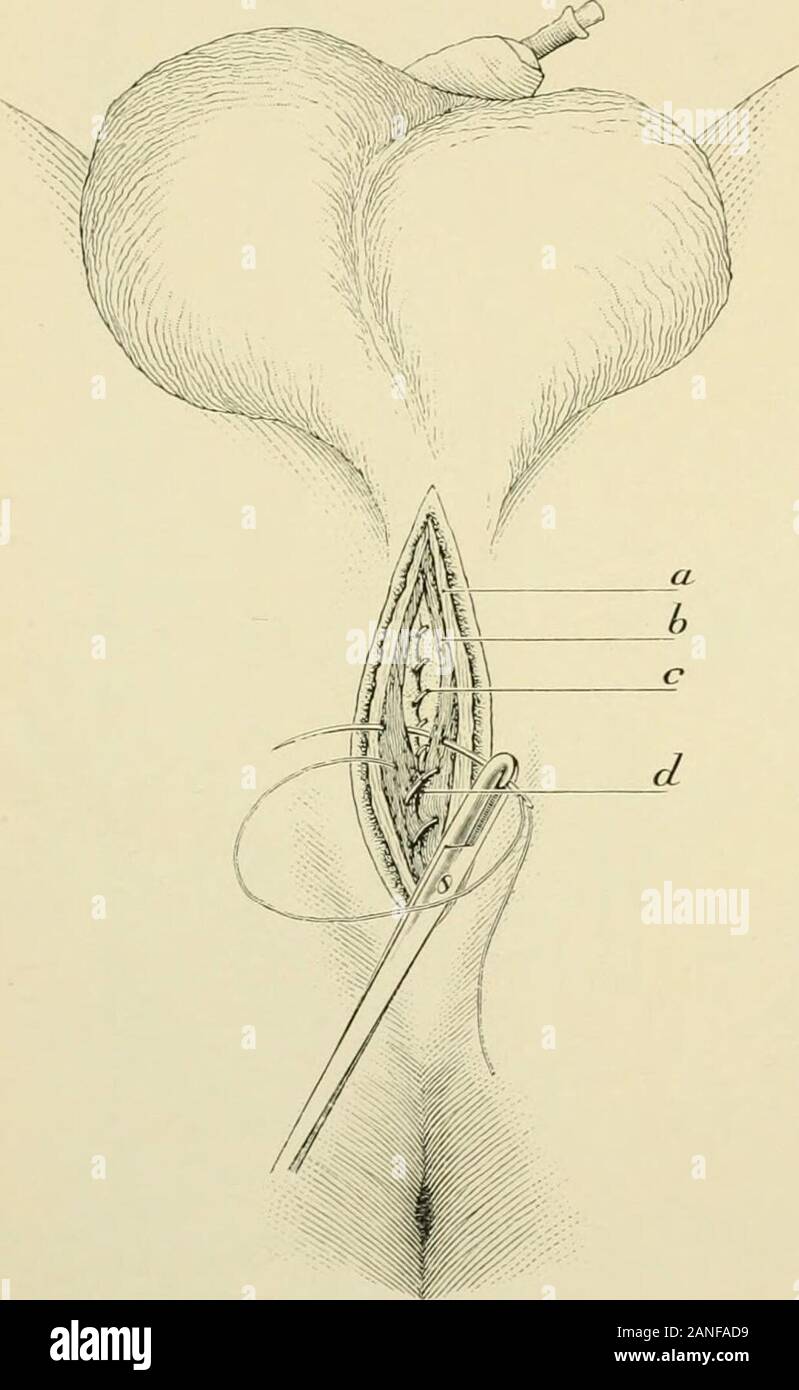 Intervento chirurgico . (Fig. 1415), o bydoubling, se il calibro dell'uretra permetterà.molta pazienza e abilità areneeded per individuare e così la Fig. 1417.-la sutura di tessuti profondi oltre la linea di uretfiral cambiare la direzione di rigidsewing, n. Superficiali scudo perineale, h. Accel- u^J; U"   . "^f •""+.."eratorurin;e muscolo, c. La linea di cucitura della uretra, corpi mediante stru-ct. Per cucire lembi muscolari su incisione uretrale. zioni aventi, o privo di meccanismo speciale per proteggere la loro consegna innocui. La presenza di cistite o di malattia renale ammonire che cura essere praticata in ogni manne Foto Stock