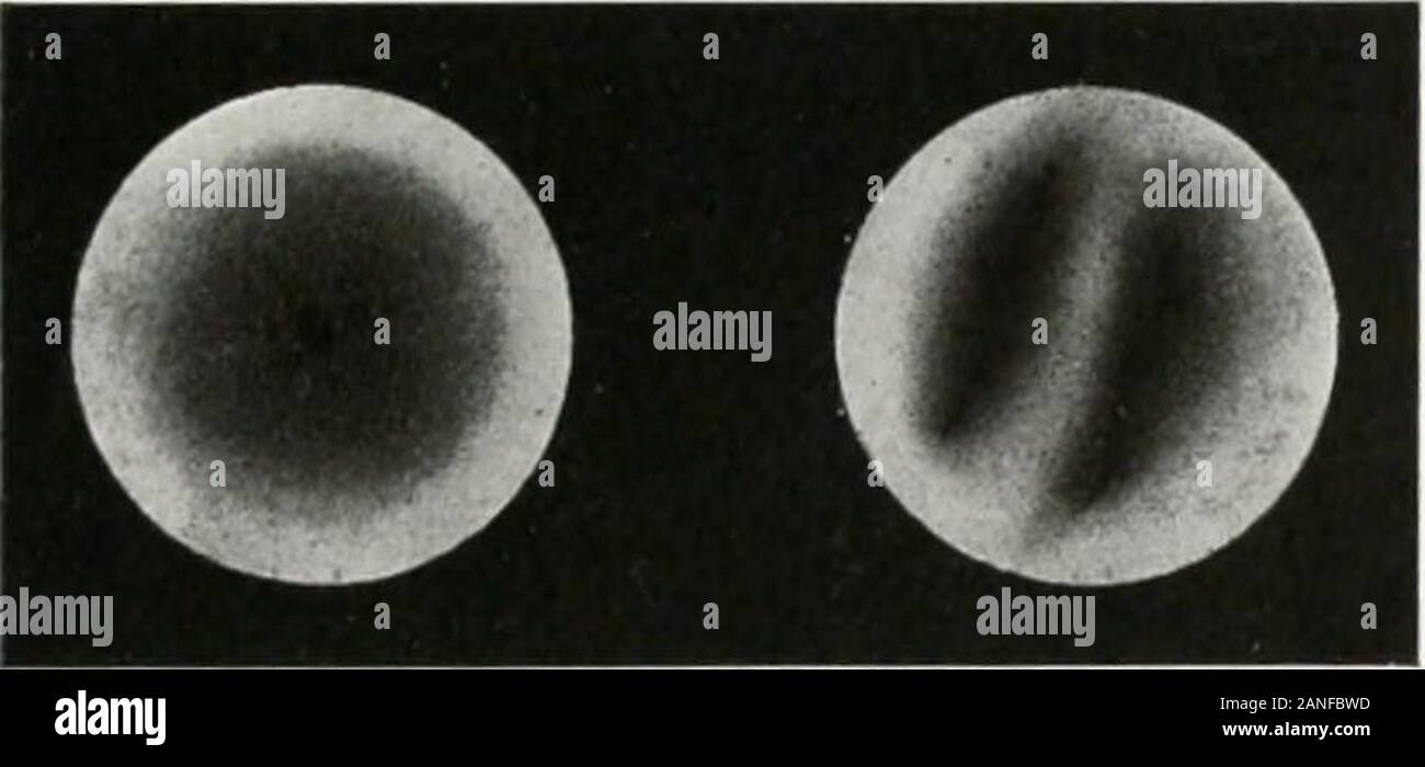 Endoscopia perorale e chirurgia laringea . C 1) Fig. 409.-viste endoscopico dei bronchi in pneumotorace in una ragazza di nove anni teen. A sinistra bronco principale. B stesso appena al di sopra del dando fuori dei leviti superiori bronco lobo. C, lobo inferiore (stelo bronco). D, gli orifizi del ramo inferiorlobe bronchi. Fncitmothorax. L'autore ha avuto tre opportunità di esame-ining bronchi in jineumothorax. Le immagini endoscopiche in uno caseare rappresentata dai disegni autiiors riprodotta in fig. 40!). Theauthor può facilmente comprendere come tale lumina potrebbe essere prodotto conla excejjtion di C (Fig. lO.M, whic Foto Stock