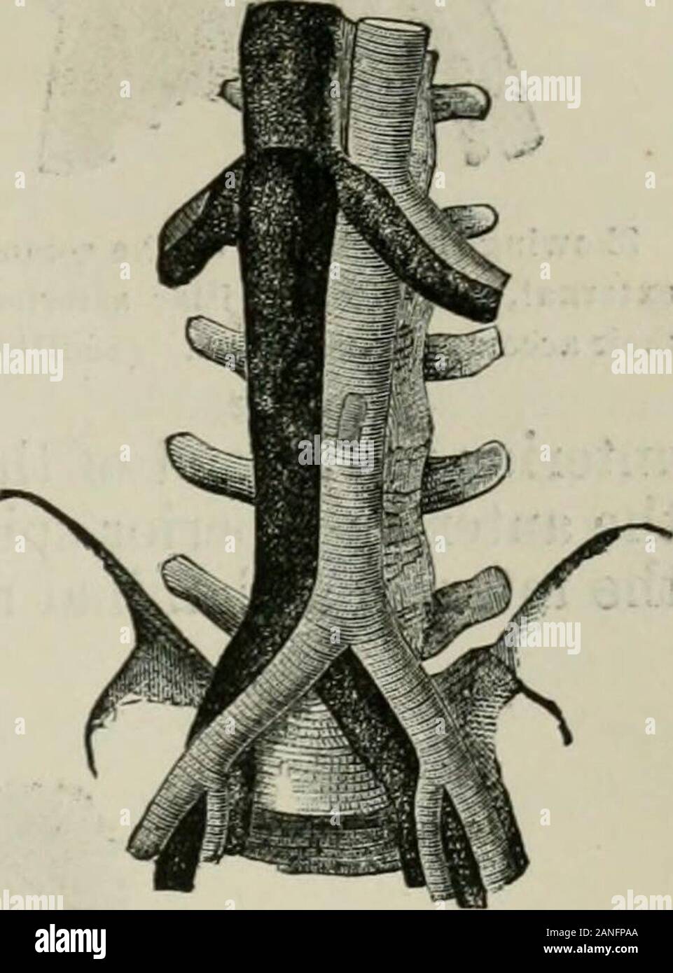 L'Enciclopedia internazionale di chirurgia; un sistematico trattato sulla teoria e la pratica della chirurgia . La ligazione dell'Arteria ulnare sopra il polso. (Sedillot.) (2) lo strato superficiale della fascia dell'avambraccio è di essere cautamente diviso -^nello stesso modo dello strato profondo. (3) l'arteria, accompagnato da due vene(venfie comites), giace tra i tendini del flessore carpi ulnaris e la parte più interna del tendine flessore sub-limis digitorum. Sulla sua sidelies ulnare del nervo ulnare (Esmarch). Il funzionamento al di sotto del Os Pisiforme.-In corrispondenza del polso, l'arteria viene eseguito sul lato theradial del pisiform bo Foto Stock