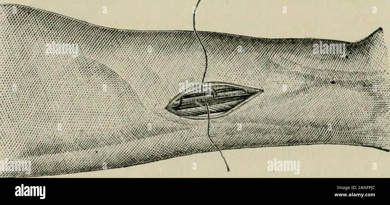 L'Enciclopedia internazionale di chirurgia; un sistematico trattato sulla teoria e la pratica della chirurgia . La ligazione dell'Arteria ulnare al junc-zione della metà superiore e terzi di theforearm. (Sedillot.) Fig. 491.. La ligazione dell'Arteria ulnare sopra il polso. (Sedillot.) (2) lo strato superficiale della fascia dell'avambraccio è di essere cautamente diviso -^nello stesso modo dello strato profondo. (3) l'arteria, accompagnato da due vene(venfie comites), giace tra i tendini del flessore carpi ulnaris e la parte più interna del tendine flessore sub-limis digitorum. Sulla sua sidelies ulnare del ulnare ne Foto Stock
