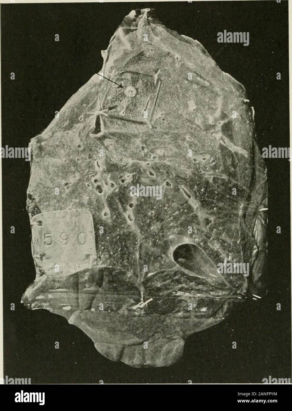 Malattie del torace e i principi di fisica diagnosi . i bacilli becomeinactive e il tessuto degenerative è in parte assorbita e in parte trans-formata in tessuto cicatriziale. Tuttavia, se il processo non becomearrested a questo punto, la malattia si diffonde al di là della sua originale e messa a fuoco aconsiderable area di consolidamento tubercolare può essere il risultato. Thedegenerated caseous o materiale può diventare poi ammorbidito e isduring questa fase di addolcimento che infezione secondaria va su perhapsmost prontamente. 312 malattie di bronchi e polmoni, alla pleura, e diaframma il deposito iniziale come vedere Foto Stock