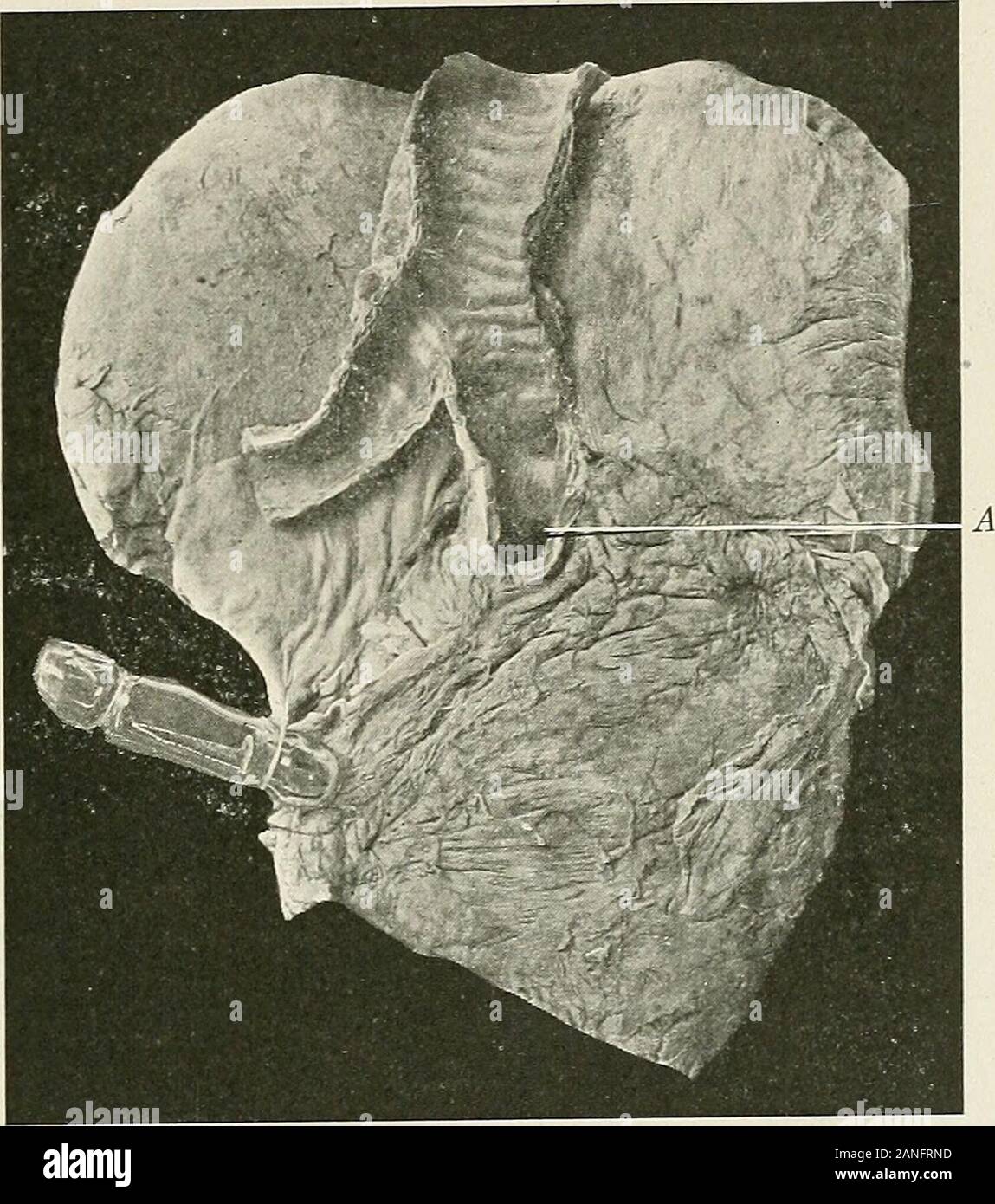 Malattie del torace e i principi di fisica diagnosi . ee figg. 225 e 226). Il passagedownward del corpo estraneo è facilitata dalla gravità e dalla in-spiratory allargamento della trachea e dei bronchi principali. Il rapiditywith che la sostanza estranea passa verso il basso è dovuto in parte alla sua 1 Endoscopia perorale e laringeo Surgerj^, 1915. - Trans, del Sec. su Laryngology, e Otology Rhinology, 1917, p. 36. Le malattie DEI BRONCHI 299 dimensioni e parte alla forma dell'oggetto. In ogni caso vi è producedirritation e spasmo della laringe e trachea e più o meno severeparoxysms Foto Stock