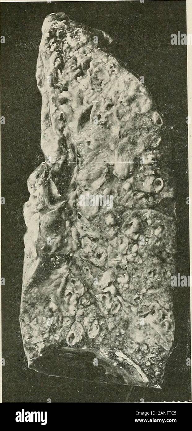 Malattie del torace e i principi di fisica diagnosi . laterale di coinvolgimento è la più frequente mentre in tuberculouscases unilaterale e coinvolgimento apicale è il più comune. Apicalinvolvement è anche piuttosto comune nei casi di pneumoconiosi. McCraeand Funk^ hanno segnalato 5 casi di bronchiectasia apicale, 4 di whichwere associato con la tubercolosi (vedere Fig. 222). Due varietà principali di bronchiectasia sono riconosciuti, cioè thecylindrical e la forma globulare o sacculated. 1 Jour. Am. Med. Assoc, il 7 ottobre 1916. Le malattie DEI BRONCHI 291 in forma cilindrica la dilatazione è uniforme Foto Stock