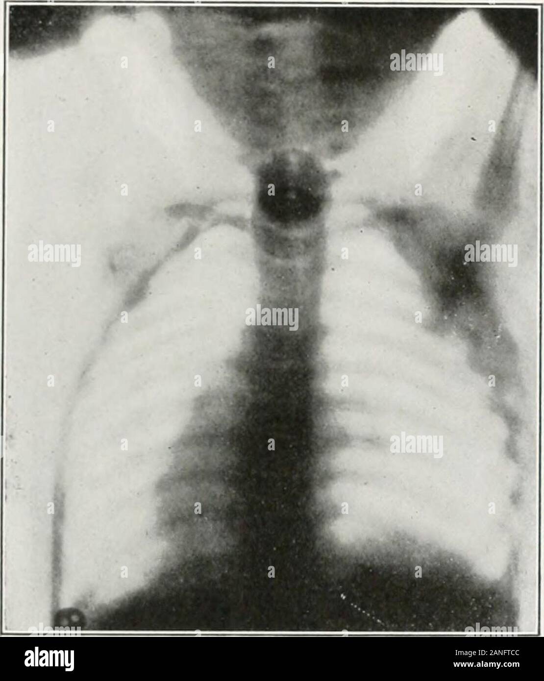 Endoscopia perorale e chirurgia laringea . Fig. 383.-La radiografia mostra moneta (Enghsh semi-penny) in esofago di agirl cinque anni di età. Rimosso da esophagoscopy speculare senza anestesia.(La Radiografia dal dottor George W. Grier. Gli autori caso.) casi illustrativi DI ENDOSCOPIA PER CORPI ESTRANEI. 415. Fu;. 384.-Radiograpli showiiiy cuin (Canadian twciitj-cinque cent) in tlicesophagus di un bambino di due anni. Coin rimosso mediante esophagoscopy. (Radio-grafico dal dottor Russell H. Boggs. Gli autori caso). Foto Stock
