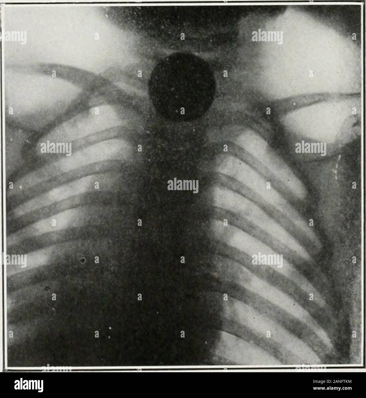 Endoscopia perorale e chirurgia laringea . Fig. 382,-la radiografia che mostra il pulsante ni esopliagu^ del neonato sedici monthsold. Rimosso da specnlar esophagoscopy senza anestesia. Radiografia (da Dr.Re. Gli autori caso.). Fig. 383.-La radiografia mostra moneta (Enghsh semi-penny) in esofago di agirl cinque anni di età. Rimosso da esophagoscopy speculare senza anestesia.(La Radiografia dal dottor George W. Grier. Gli autori caso.) casi illustrativi DI ENDOSCOPIA PER CORPI ESTRANEI. 415 Foto Stock