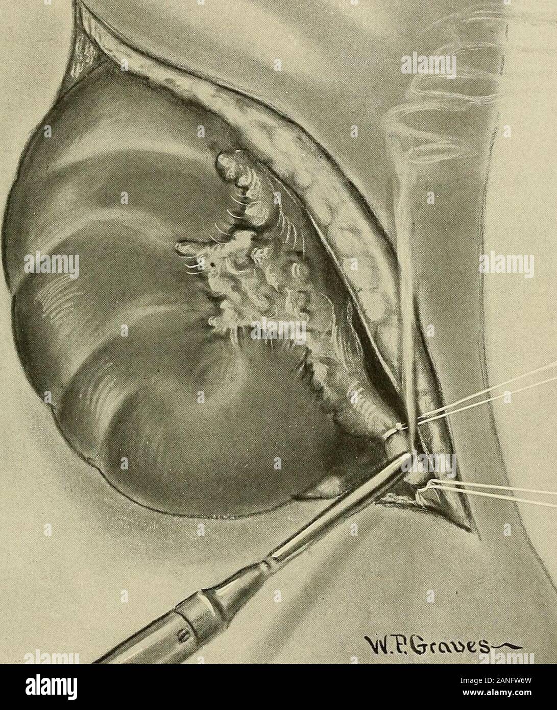 Ginecologia . VvatvsvjfcS;un;^ Fig. 402.-nefrectomia.esposizione della capsula di grasso. Operazioni sul rene 695 quando la capsula di grassi è stata divisa, l'impresa, superficie liscia di thekidney può essere sentita. I morsetti sono messi sul grasso per disegnare il rene fino towardthe avvolto e facilitare il passo successivo, che è quello di separare il grasso anddeliver capsula renale. La capsula è metodicamente distaccata dal dito, anteriore e poste-rior superfici essendo prima liberato con piccolo problema. Per liberare il polo superiore thecapsule è normalmente più aderente, e se la malattia infiammatoria è presentserious di Foto Stock