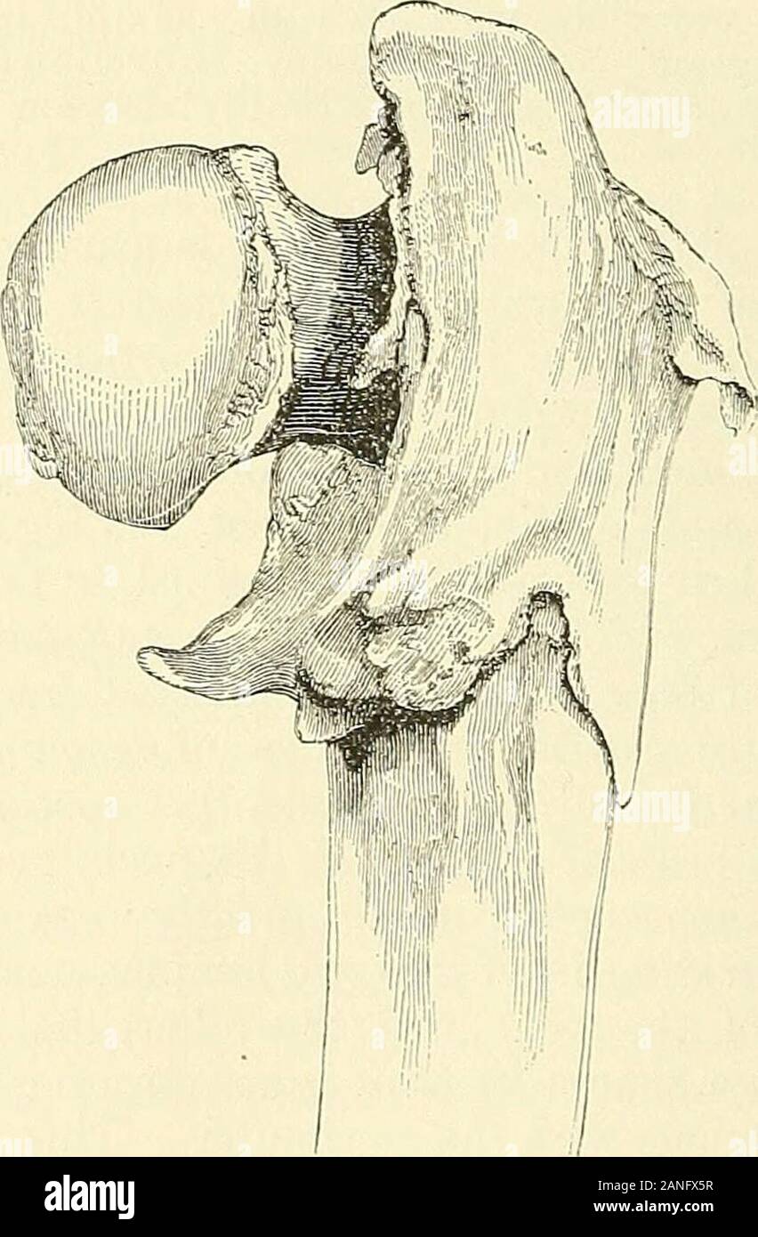 Una pratica Treatise on fratture e lussazioni . oper, da B. Cooper, op. cit., p. 151, nota. 360 le fratture del femore. Come per ricevere nell'intervallo tutto il collo, invece della parete posteriore solo,come avviene comunemente. Il dottor Robert Smith, di Dublino, cita un caso analogo verifiedby l'autopsia; e il dottor Bigelow commento che il campione numerate 248 trovanella Mutter museum, a Philadelphia, presenta lo stesso tipo di impatto con-out o di inversione o di eversione. Diagnosi.-frattura del collo all'interno della capsula non è usuallyattended con tanto dolore quando il paziente è a riposo, ma qualsiasi tentativo Foto Stock