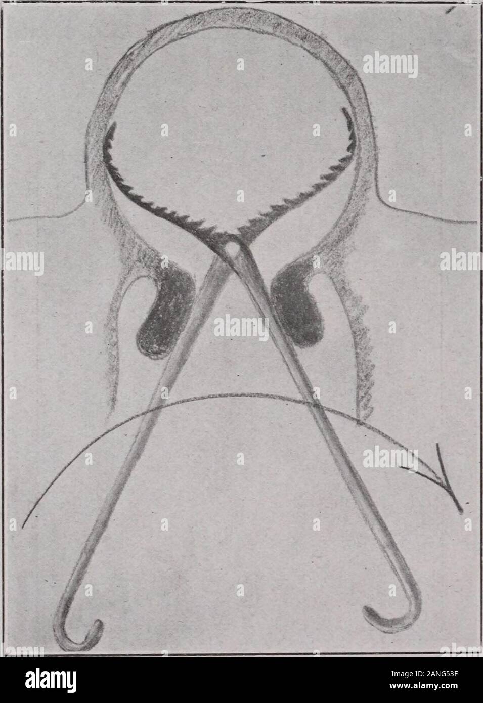 Le transazioni della Associazione americana di ostetrici e ginecologi e chirurghi addominale per l anno ... . St essere in grado ofexpansion interamente sopra lo stretto canale cervicale; deve essere così con-structed come per raggiungere ogni zona della parte interna del collo dell utero andclear è staccata di tessuti della placenta e delle membrane; e quando isdone che essa dovrebbe essere in grado di essere chiuse e ritirati, portando withit la placenta e le membrane in modo tale che nessun danno è doneto il paziente e con un minimo di dolore. Ho ideato un tale strumento in due formati, e anche se ho 292 C. E. RUTH Foto Stock