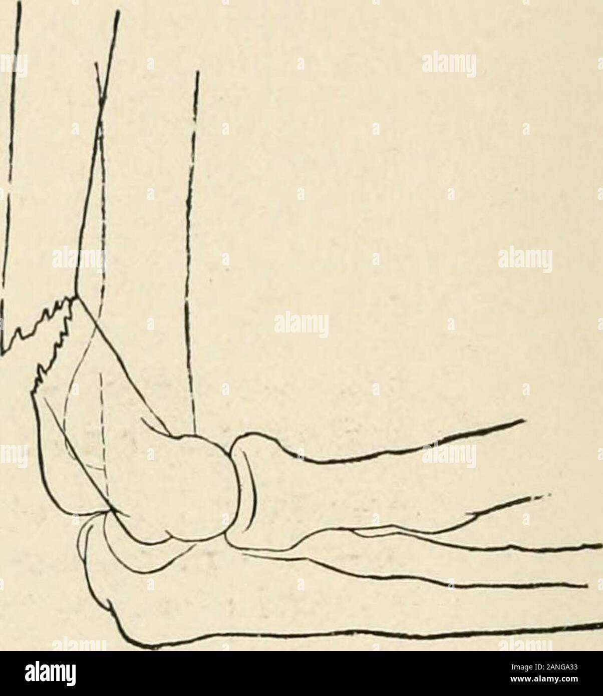 La pratica della chirurgia . Fig. 571.-frattura Supracondyloid.Obliquità della linea di frattura da essere-hind verso il basso e in avanti. Diagramshowing deformità con gomito flesso andlittle scorrimento dei frammenti (Scudder). Fig. 572.-frattura Supracondyloid.obliquità del hne di frattura fromabove verso il basso e all'indietro. Dia-grammo che mostra la tendenza a posteriore de-formity se la flessione acuta di avambraccio isattempted (Scudder). r ^. essenziale per il forte e la corretta estensione dell'avambraccio; il elbowfractures abbiamo discusso finora interferiscono con il corretto flexionmainly. In questi casi abbiamo visto che un r Foto Stock