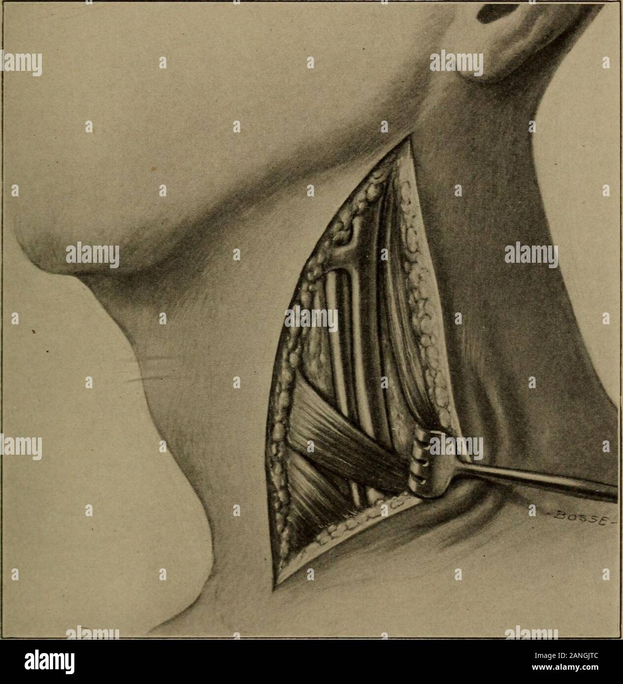 Un manuale di otology per studenti e professionisti . ly sopra la clavicola per nearthe angolo della mandibola, e si estende attraverso la pelle,fascia superficiale e platysma myoides e usuallyreveals le fibre del muscolo sternomastoid. Se nonsi, questo muscolo dovrebbe essere cercato spingendo indietro theposterior margine della ferita con il manico di thescalpel. Dopo aver posizionato il margine anteriore del thismuscle, è trattenuto con un retrattore smussato. Un anteriorretractor non è consigliata in quanto la relazione delle parti è oftenobscured dal suo utilizzo. Per tutto il resto della dissezione operationblunt Foto Stock