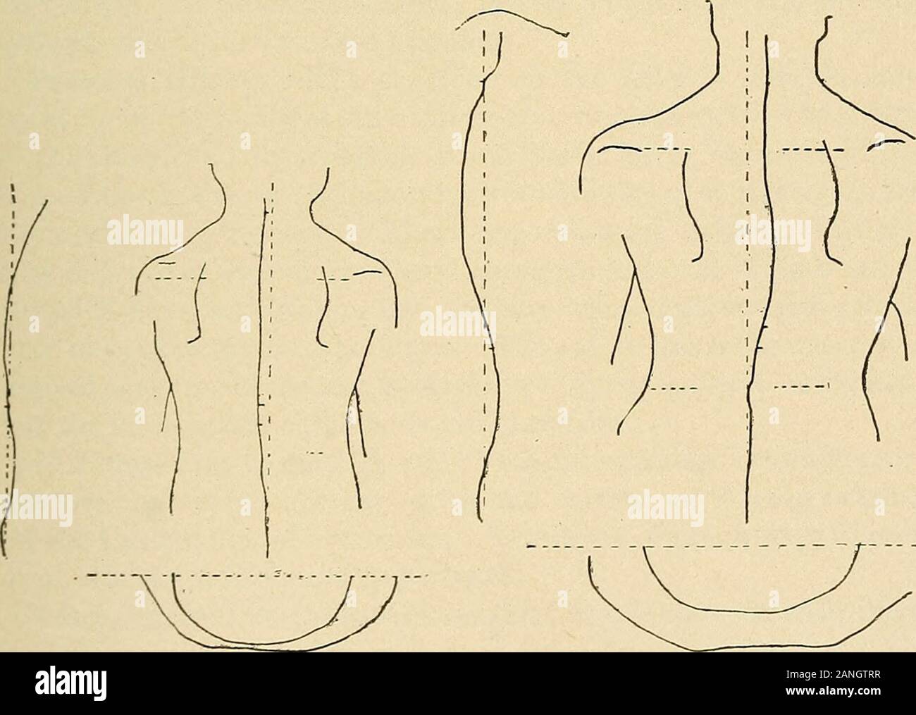 Curvatura laterale della colonna vertebrale e rotonde spalle . FiG. 57.-grave rotazione dorsale sul lato destro in flessione in avanti.. Fig. 58.-ScHULTHESs di tastatura aGirl sei anni.-(SchuUhess.) Fig. 59.-la traccia del S.me caso EightYears più tardi.-(SchuUhess.) temente dall'aggiunta di curve di compensazione, per esempio la illustrationshows il cambiamento di una dorsale di sinistra a destra della curva lombare per una curva dello stesso tipo causando, tuttavia, una diversa distorsione. In generale, come mai la successiva distorsione è un'esagerazione del precedente. 70 DESCJIIPTION i sintomi e la frequenza relativa dei tipi comuni come tabu Foto Stock