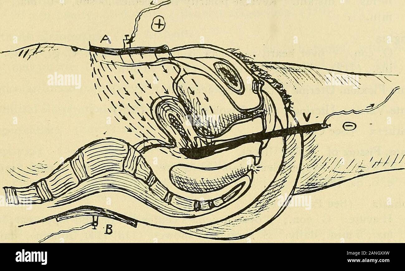 Il gruppo elettro-guida terapeutico o, un migliaio di domande e risposte . a mano o a rullo, J- oltre abd., - invag., 10-30 min., e. o. d. Peccato. nello stesso modo, (82, 142). Afterpains, per verificare post-partum emorragie F. sec (breve bobina grossolana) o g. alt., o peccato., da int.-ut., per abd.,(Bennett disco), (82, 142), gonfiore corrente, (52), (75). Afterpains F. sec, (long ammenda bobina), dal retro per abd. o g. cost., + ABD., Ben-net disco, (52), (81), (142), - torna, 10-20 ma.. 15-30 min. Agitans, paralisi (vedere la paralisi) alcolismo elettro-bagni di vapore, (92). Luce elettrica bagni, (187). Violetta lightbaths, Foto Stock