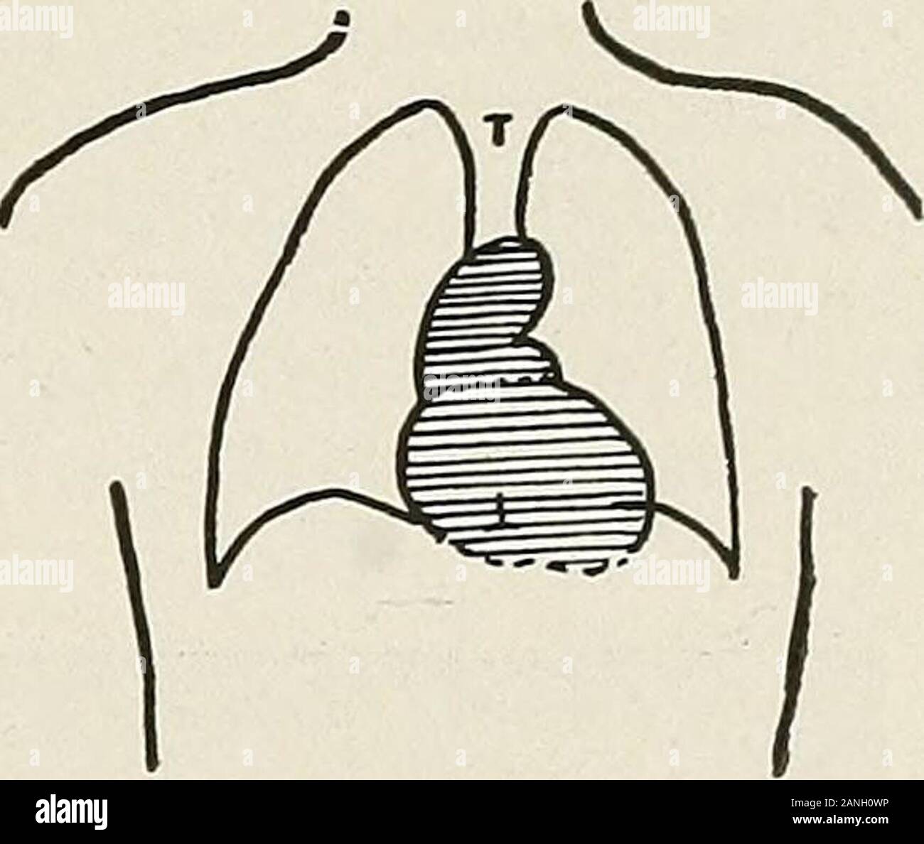 Malattie del torace e i principi di fisica diagnosi . Insufficienza aortica. Ostruzione aortica. Foto Stock