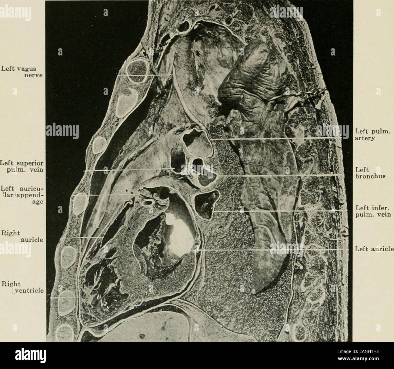 Malattie del torace e i principi di fisica diagnosi . del orthodiagraph. La linea tratteggiata illustra la penetrationof obliqua percussioni vibrazioni. A-B, orthodiagram ombra. A-C, percussioni dulness. Lightvertical percussioni (orthopercussion) riduce al minimo la radiazione laterali e fornisce la maggior parte delle ca-curato i risultati ottenibili con le percussioni. La tendenza è generalmente a sovrastimare leviti e a sottovalutare il diritto di confine cardiaco. Il margine di errore è aumentato incases del ventricolo sinistro e di allargamento in pazienti con profonda thoraces. Ulteriori mostra la situazione di profonda o Foto Stock