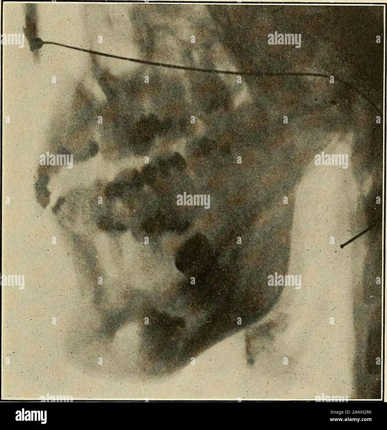 Chirurgia orale; un libro di testo sulla chirurgia generale e medicina come applicata per odontoiatria . - Corretto un NG te  Per incisivo WtTH bassa RAl-ATIwe ARCH. Fig. 225.-Il metodo corretto di assunzione di raggi X della ganascia. deve mostrare il antrums richiede una notevole lunghezza ofexposure, solitamente il cinquanta per cento milliampere secondi.Un film di degli incisivi, al contrario, richiede buttwenty per trenta secondi milliampere. Film un pollice e aquarter da un pollice e mezzo sono circa grande come può essereusato in maniera soddisfacente entro la bocca. Essi possono essere ob- X-RAY IN CHIRURGIA ORALE 429 tained pronto piegato dalla Eastman Company, Foto Stock