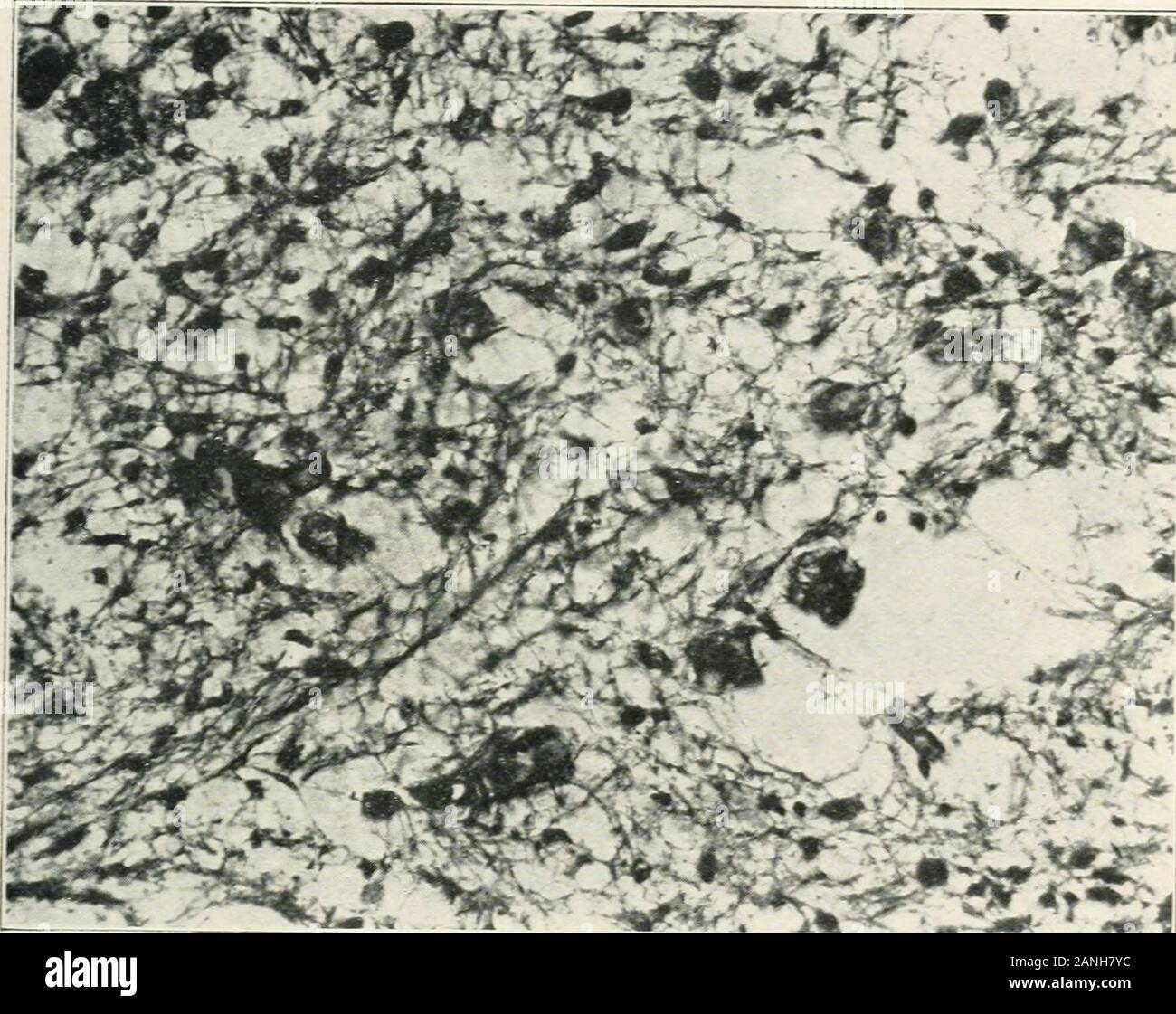 AMAarchives di Neurologia e psichiatria . tramite il processo di colorazione allo stesso tempo, thechanges descritto in altre regioni può essere considerato come una vera e propria. SCHALLER-OLIFER-EPIDEMIA EXCEPHALITIS Q mentre il intraceUular nbrillae delle cellule piramidali sono state chiaramente fuori-rigato per tutta la lunghezza delle celle e dei suoi processi, in quelle cellswhich mostrava anomalie con il blu di metilene macchia, colpendo changeswere visto. In molti casi il fibrillae dei processi cellulari, dendriti andaxons, erano abbastanza ben conservati. Al loro ingresso nel corpo cellulare, come sempre, hanno perso rapidamente th Foto Stock