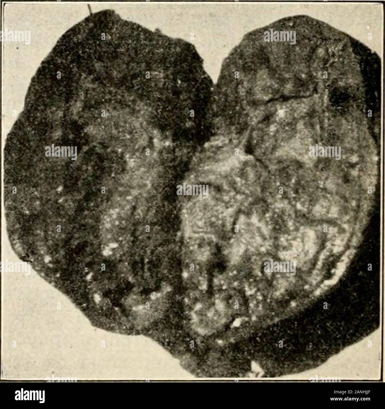 Sud della medicina e chirurgia [numero] . un tubo stelo. Essa è stata divisa withcautery e suturato alla pelle per preventcontamination dell'incisione. Thewound era chiuso a strati con scarico onecigarette al moncone del peduncolo.Sezione di rene effettuate a seguito di opera-zione, mostra molte grandi tuberculous cav-ities con vari stadi di tuberculosispresent. Molti tubercleswere conglomerato visto. La pelvi renale è stata linedwith una membrana pyogenic e com-municated con diverse delle cavità. Convalescente Record: il incisionhealed per primam tranne il drain sitewhich rapidamente chiuso mediante granulazione.Su 12-28-2 Foto Stock
