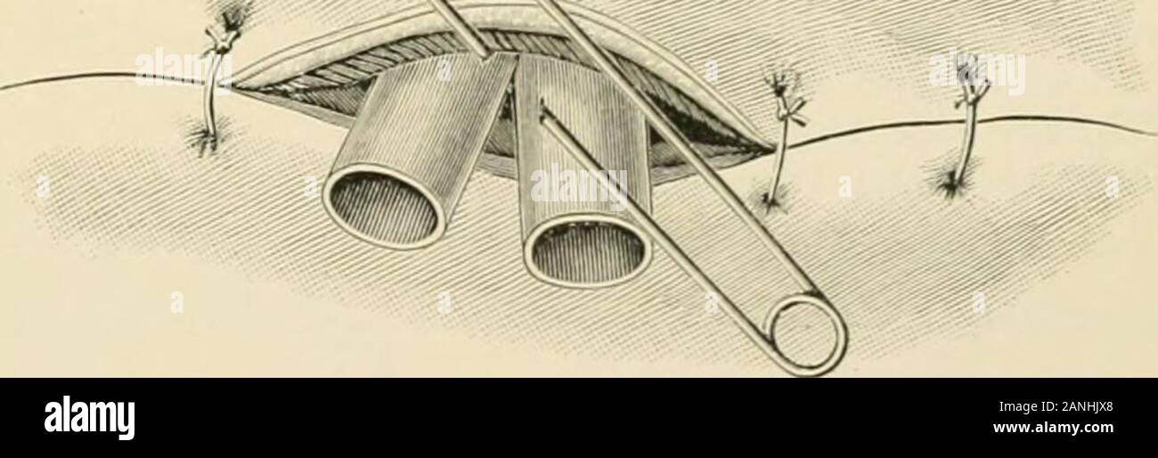 Intervento chirurgico . th drenaggio. L'incisione è cautiouslymade su di pus, invece di immettere la raccolta in una volta sola per asudden spinta. Quest'ultimo piano è inutile e pericoloso inutilmente.Dopo la fuoriuscita del fluido e della linfa prodotti, drenaggio è estab-fissate come nelle precedenti operazioni. Tuttavia la forte inclinazione dell'apertura per chiudere a causa del ravvicinamento delle nervature richiede chela agente di drenaggio è non di rado hanno pareti rigide. Per soddisfare thisindication abbiamo in molti casi utilizzato allo scopo il ordinarylarge-dimensionato la guttaperca (F Foto Stock