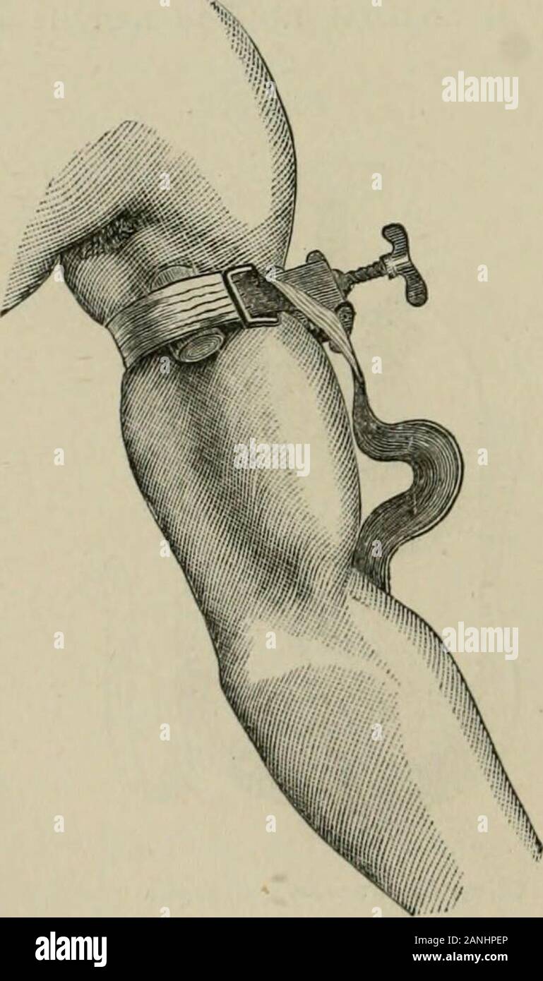 L'Enciclopedia internazionale di chirurgia; un sistematico trattato sulla teoria e la pratica della chirurgia . FifT. 352. Fi-. 353.. La compressione della arteria brachiale da un screwtourniquet. (Esmarch.) la piastra tourniquet isdisplaced per visualizzare l'applicazione dell'compressin la linea dell'arteria; la piastra è regolata im-mediately oltre il comprimere la prima fascetta istightened. Foto Stock