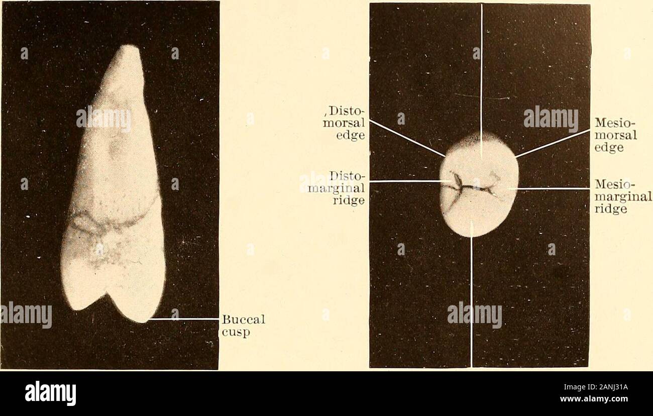 Principi e Pratica di odontoiatria operativa . ck, e spesso strozzata themiddle, dando ad esso il contorno di una clessidra. Più spesso, tuttavia, ithas due paste distinti canali. La porzione coronale del canale terminatesin due ben definita cornua o le corna che puntano verso le cuspidi della corona. La lunghezza media del primo bicuspid è di 0,80 pollici (2,03 centimetri),della corona di 0,32 pollici (0,81 centimetri), e della radice 0,48 pollici (1,21 centimetri). Il superiore secondo bicuspid in modo quasi somigliante al primo che itsdifferences solo bisogno di essere notato. È in ogni modo un po' piccola Foto Stock