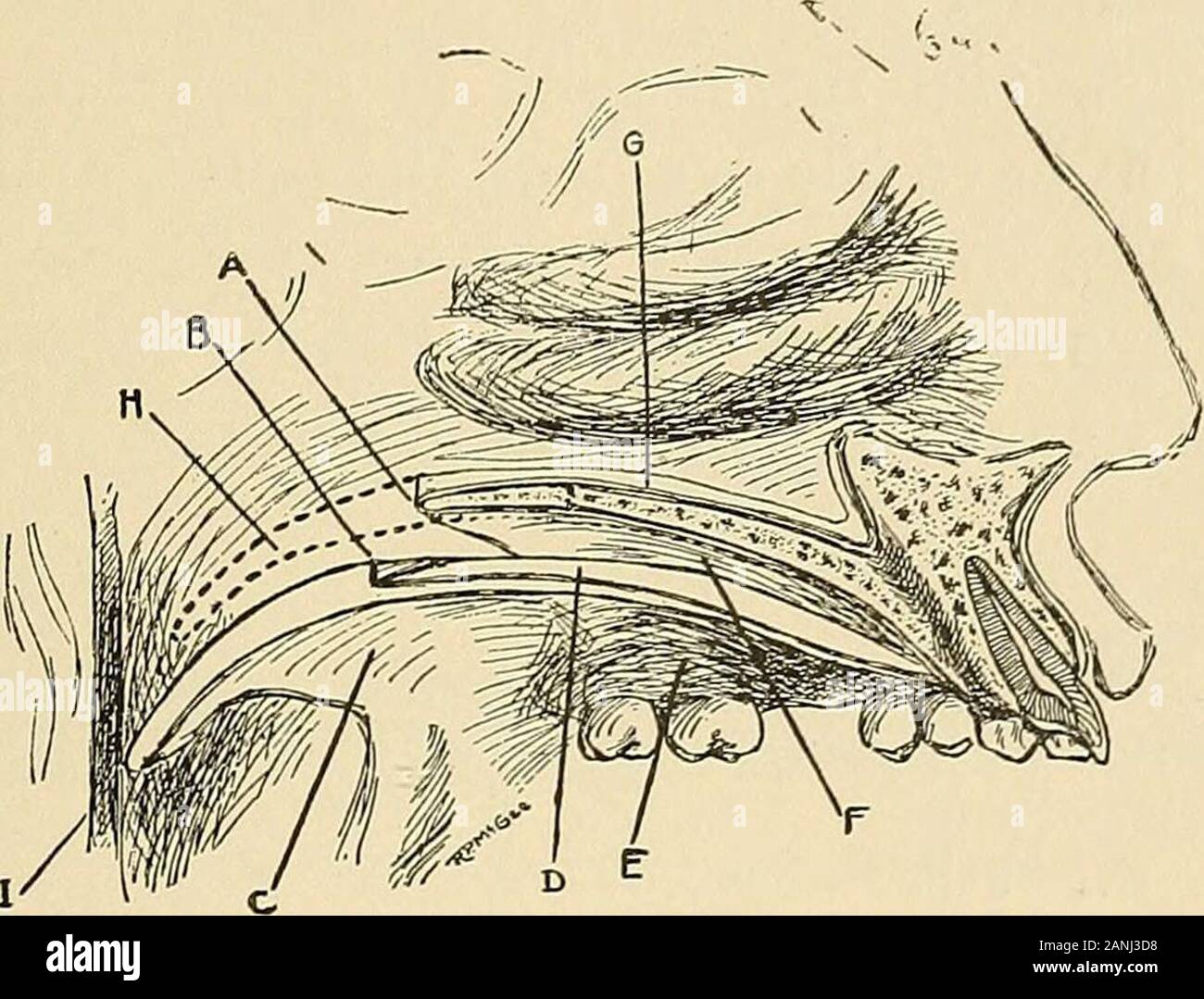 Chirurgia orale; un libro di testo sulla chirurgia generale e medicina come applicata per odontoiatria . Fig. 160.-Le tre fasi InClosing il palato molle andPractically stesso INIethodOF la chiusura del palato duro.illustrante il funzionamento Baldwans. Operazioni 331 orizzontale lungo e due brevi incisioni perpendicolari fuori-linea lo sportellino, il quale viene poi staccata con un sottile periosteo-tome e riflessa verso il basso e la sua base rimanga attaccato. Fig. 161.-superiore sinistra osso mascellare con parti associativo, Il-lustrating chirurgia del palato, a. Bordo posteriore del horizontalplate di sinistra del palato osseo. b. Velum separate fr Foto Stock