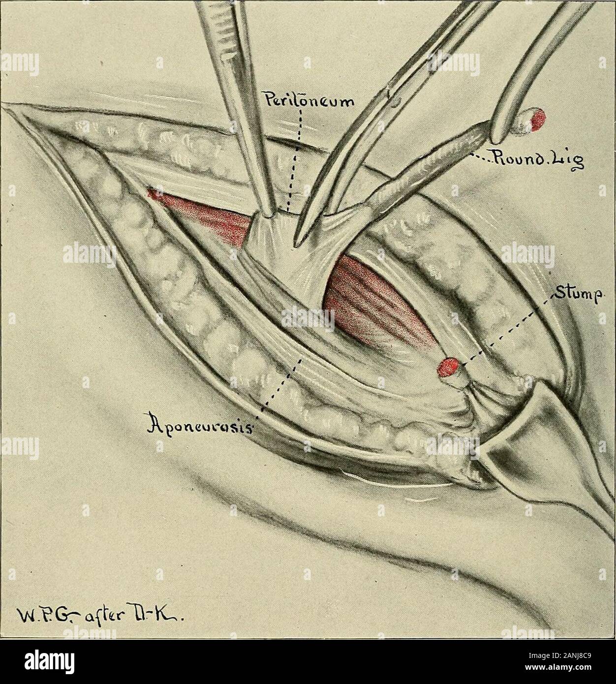 Ginecologia . ncision viene realizzato parallelo al legamento Pouparts come nell'operazioneper ernia inguinale. L'incisione attraverso la pelle, il grasso e la fascia superficiale iscarried giù per il bianco luccicante fascia del muscolo obliquo esterno. Theexternal anello inguinale è esposto, facilmente riconoscibile per la divergenza delle fibre thefascial e dal suo rispetto alla colonna vertebrale pubico. Le fibre della parte esterna 590 obliquo di ginecologia sono divisi sopra l'anello esterno in una direzione parallela con Poupartsligament. In casi normali round di legamento può essere visto facilmente giacente in thebed del canale inguinale, ma io Foto Stock