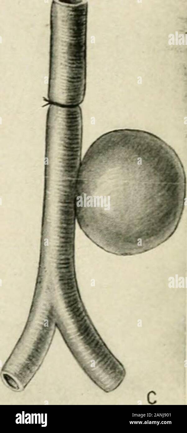 La pratica della chirurgia . ?Ig. 486.-A operazione di Antyllus; B, Funzionamento del cacciatore; C, il funzionamento di Anel. casi in tutti i quali vi era indubbio rilievo sintomatico, thoughpermanent cure non sono state stabilite. Il metodo consiste nel passinginto l'aneurisma di notevole lunghezza (molti piedi) di una multa silverwire e inoltrarla al electroljsis per venti minuti o mezza anhour. ? La coagulazione avviene prontamente e il filo viene lasciato in situ. E. Lancereaux ^ è riuscita ad arrestare il progredire della internalaneurysm da iniezioni di siero di gelatina, che egli asserisce essere t danno-meno se il siero è Foto Stock
