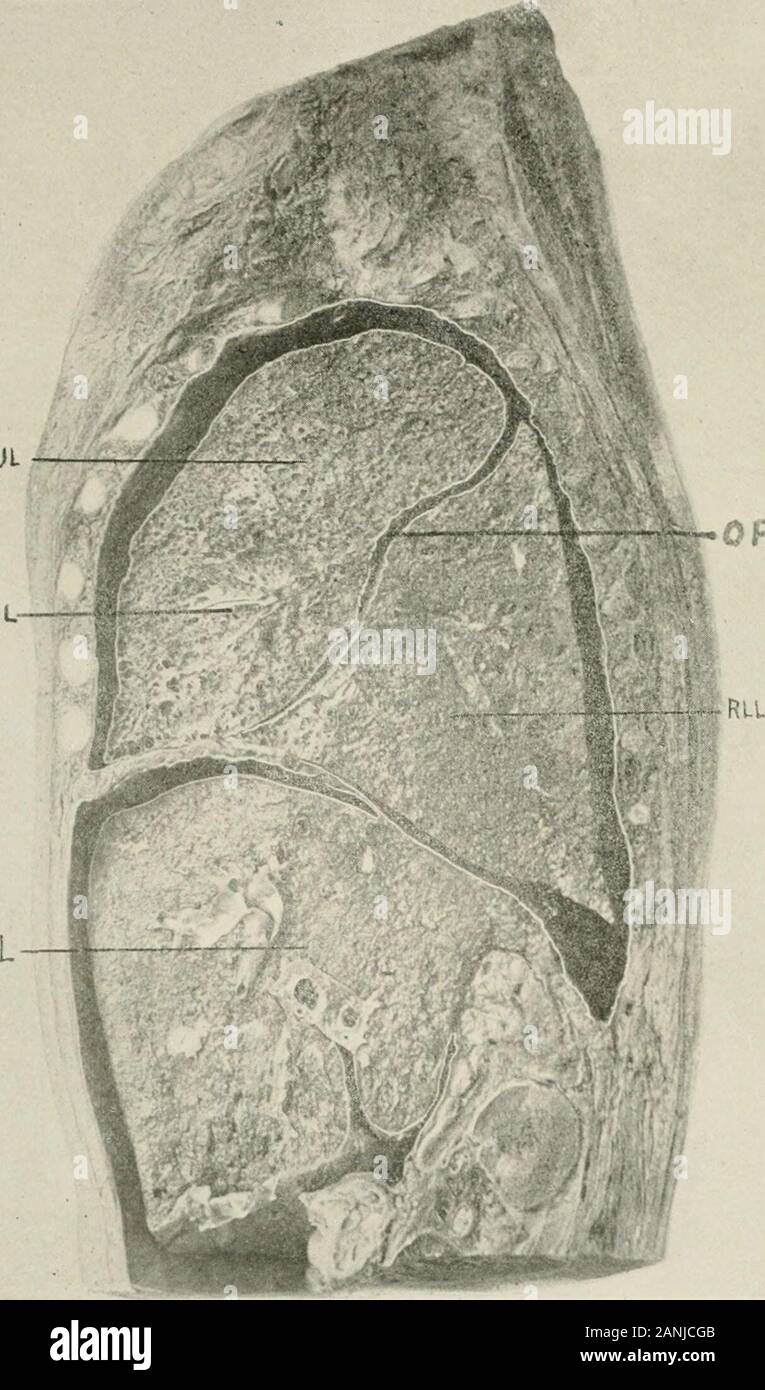 Malattie del torace e i principi di fisica diagnosi . Fig. 110.-sezione sagittale, visto rom sinistra, del corpo di un nexv-horn bambino, theplane della sezione essendo 2 cm. a destra della linea midsteriial. A causa di aderenze thehorizontal fessura non è mostrato. L. fegato; R.M.L., lobo medio del polmone destro; R.U.L., upperlobe del polmone destro; O.F., fessura obliqua; 72.L.L., lobo inferiore del polmone destro. (Feiterolf andGitlings.) i suoni vocali 137 non è una conditio sine qua non. Il suono è raramente sufficientemente distinti per consentire usto riconoscere ogni singola parola. La voce sussurrata è suscitata da Foto Stock