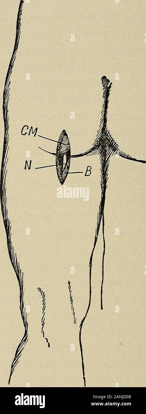 Intervento chirurgico, per studenti e professionisti . e greatsciatic nervo, che compaiono sotto il pyriformis e le navi internalpudic e nervose. Il pudic interna di vasi e nervi, afteremerging dal bacino attraverso il grande sacro-foramen sciatico,curva intorno al minore sacro-legamento sciatico, vicino all'ischio,e passano in avanti nella parte profonda del perineo. Stketciiing nervo sciatico.-Il paziente giace sul ab-domen con un sandl)ag sotto la parte inferiore del tronco. Un incisionthree pollici lungo è realizzato sul retro della coscia e la parte superiore estremitàdel incisione corresp Foto Stock