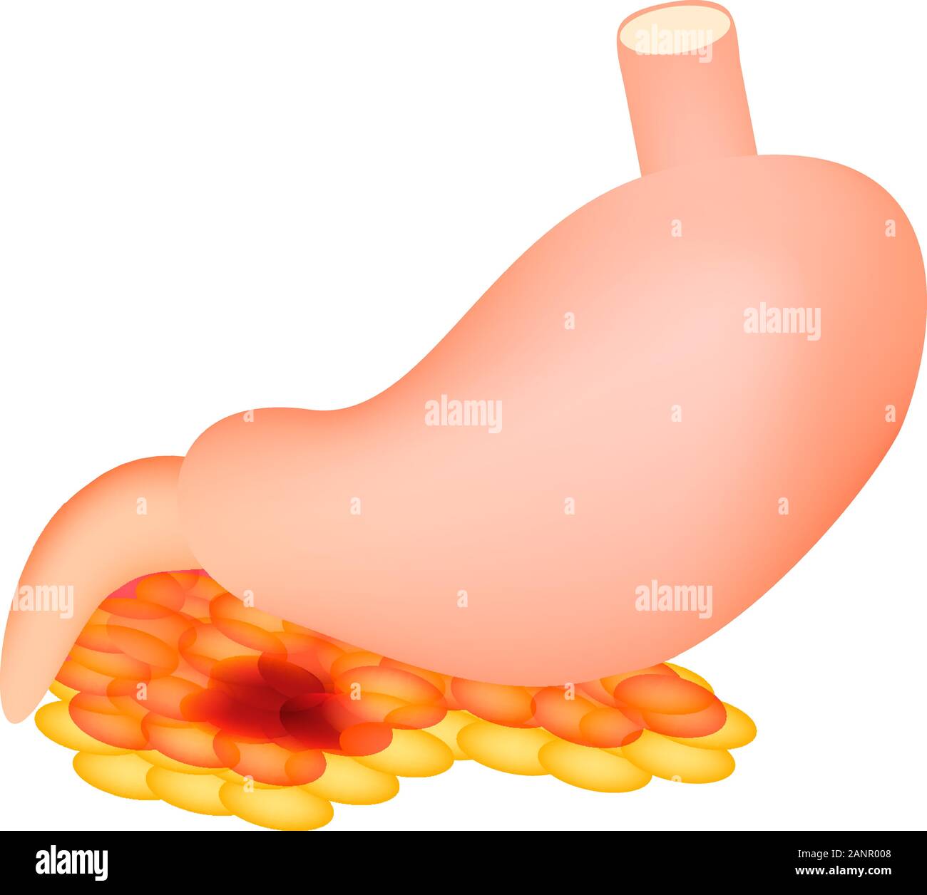 La pancreatite. La struttura dello stomaco e del pancreas. Infographics. Illustrazione Vettoriale su sfondo isolato. Illustrazione Vettoriale