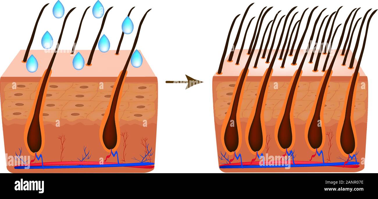 Il trattamento di alopecia. Vitamine capelli. La biotina. Seborrea la pelle  e i capelli. Forfora, dermatite seborroica. Calvizie, la crescita dei  capelli, la calvizie. Anatomica per Immagine e Vettoriale - Alamy