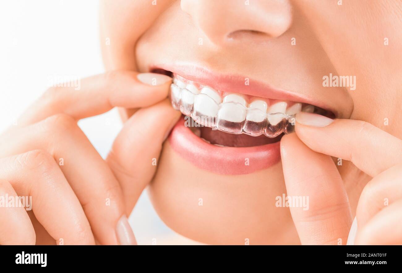 Donna che indossa il silicone ortodontico trainer. Invisibile allineatore di bretelle. Mobile apparecchio ortodontico per la correzione dentale. Foto Stock