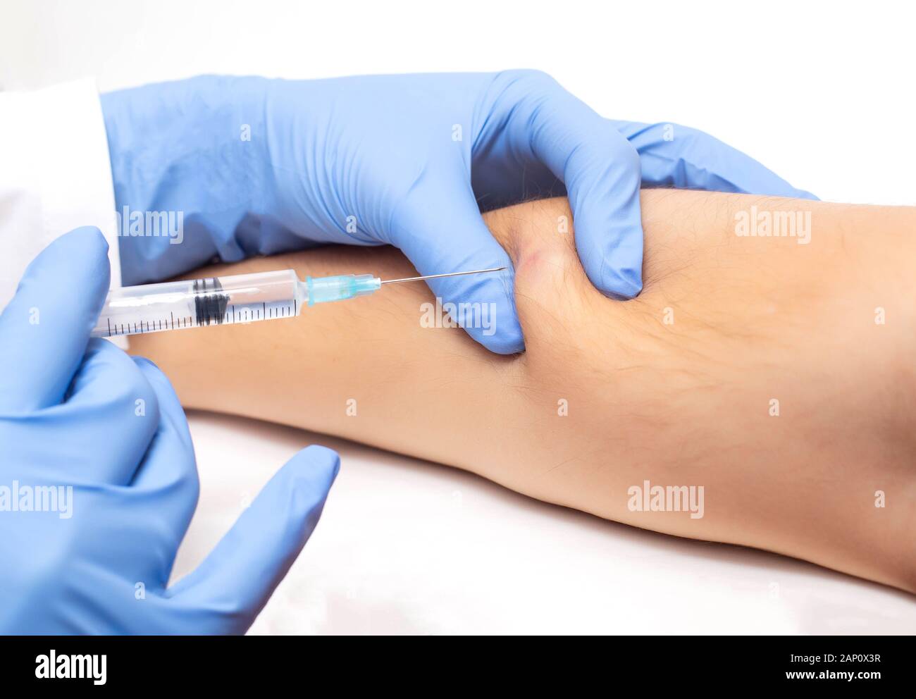 Il medico utilizza una siringa a prendere una biopsia di pelle dal paziente. Il concetto di maligne lesioni sottocutanee Foto Stock