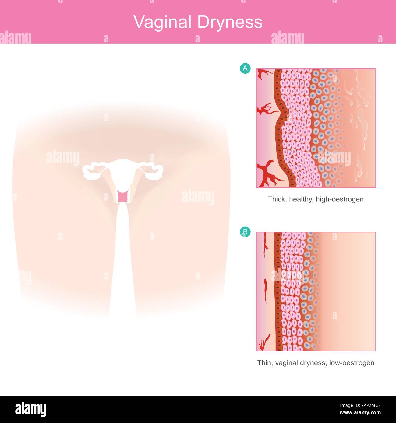 La secchezza vaginale. Il tessuto vaginale area di strati sottili e secchezza quando il volume di ormone estrogeno è ridotta. Immagine che mostra la sanità e la medicina. Illustrazione Vettoriale