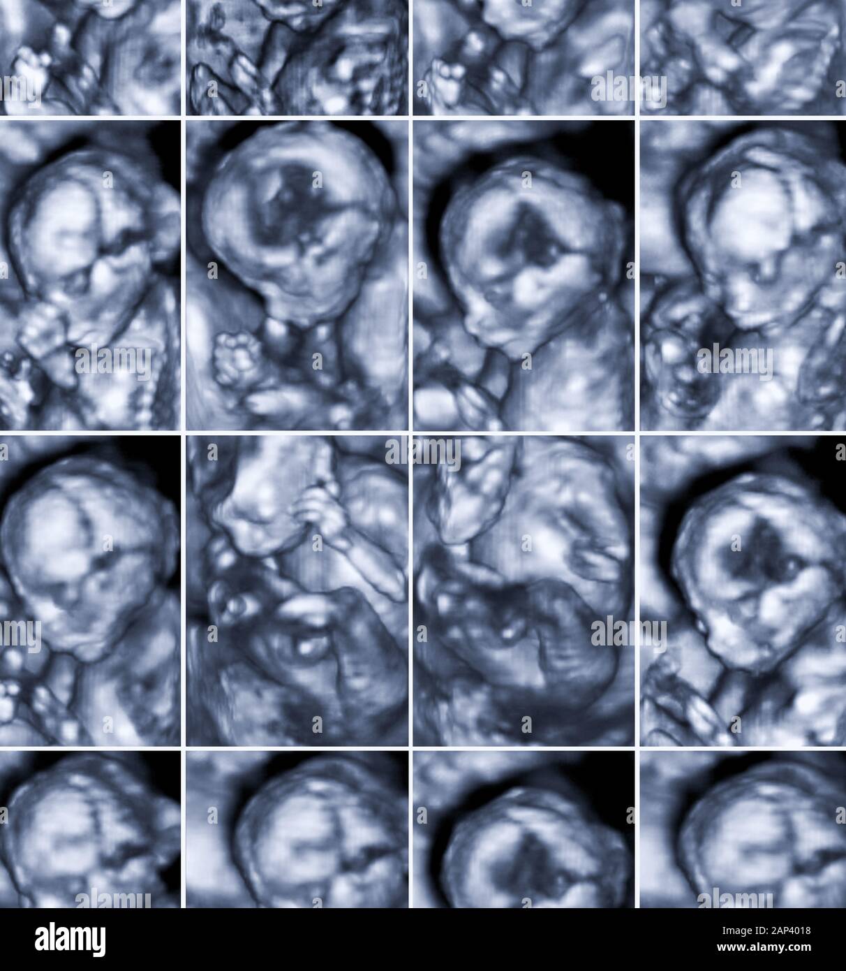 Collage di 16 immagini mediche di 3D a ultrasuoni scansione di anomalia su un feto femmina 4 mesi in gravidanza. Foto Stock