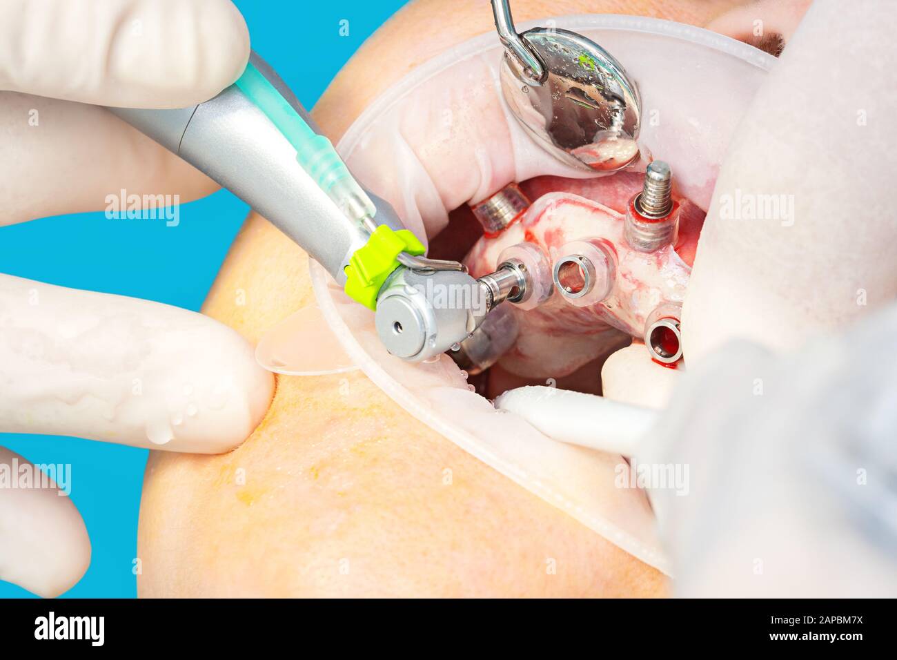 Primo piano della chirurgia implantare guidata digitale sul paziente - nuova tecnologia implantare in odontoiatria. Foto Stock