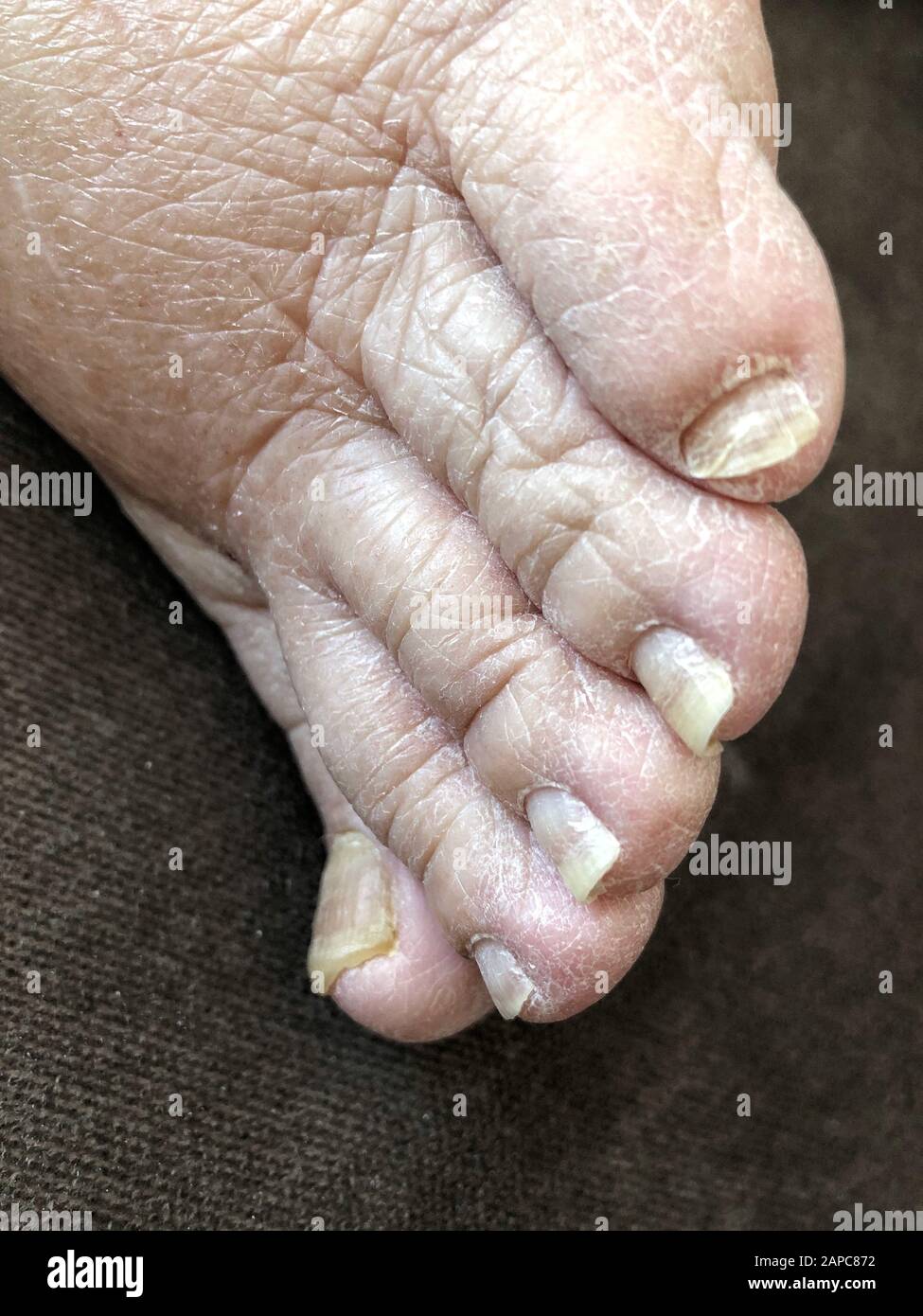 chiodo di garofano del piede femminile con chiodi danneggiati a causa di fungo Foto Stock