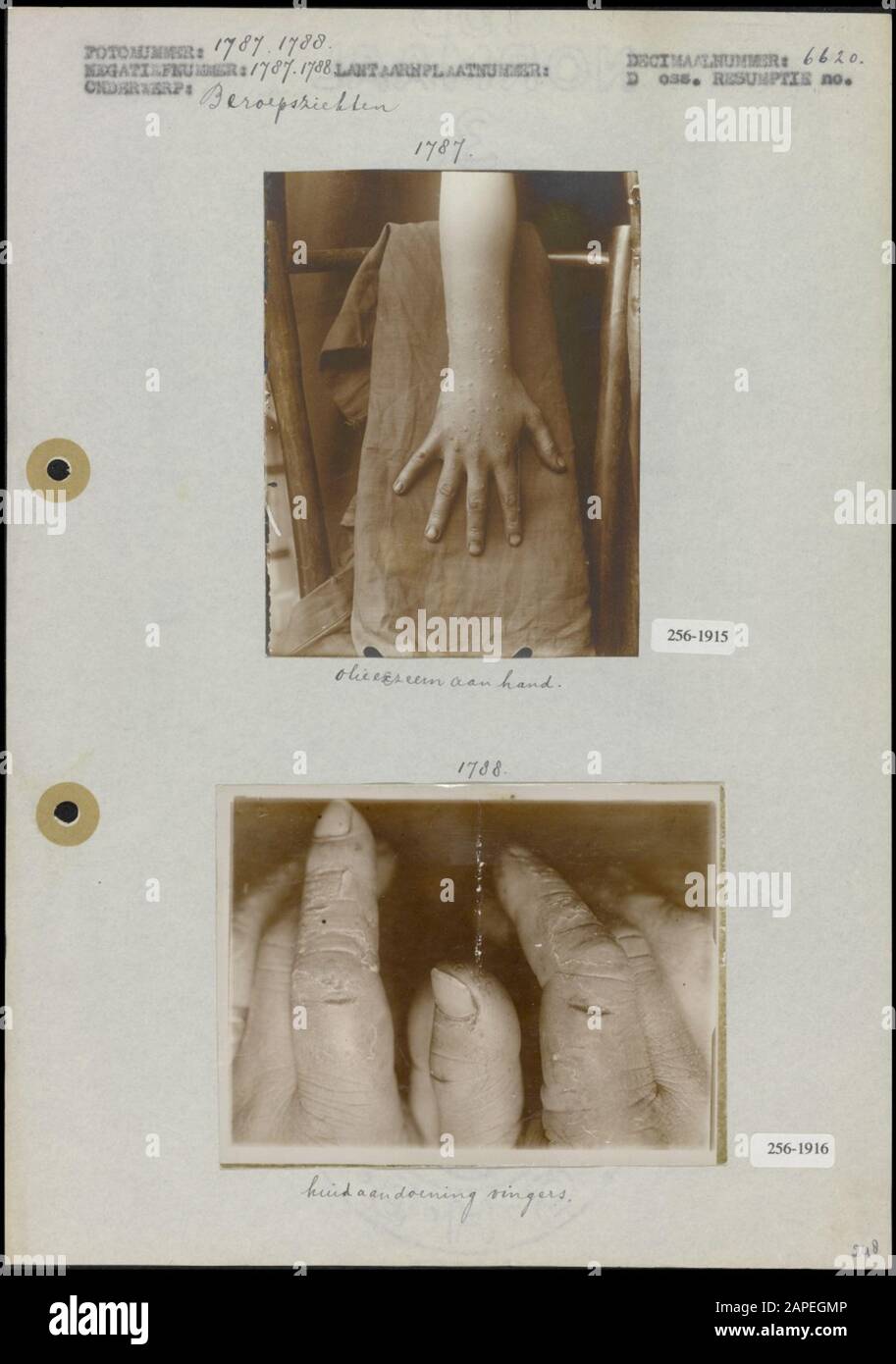 Descrizione: Disturbi della pelle a mani e dita Data: Sconosciuto Foto Stock