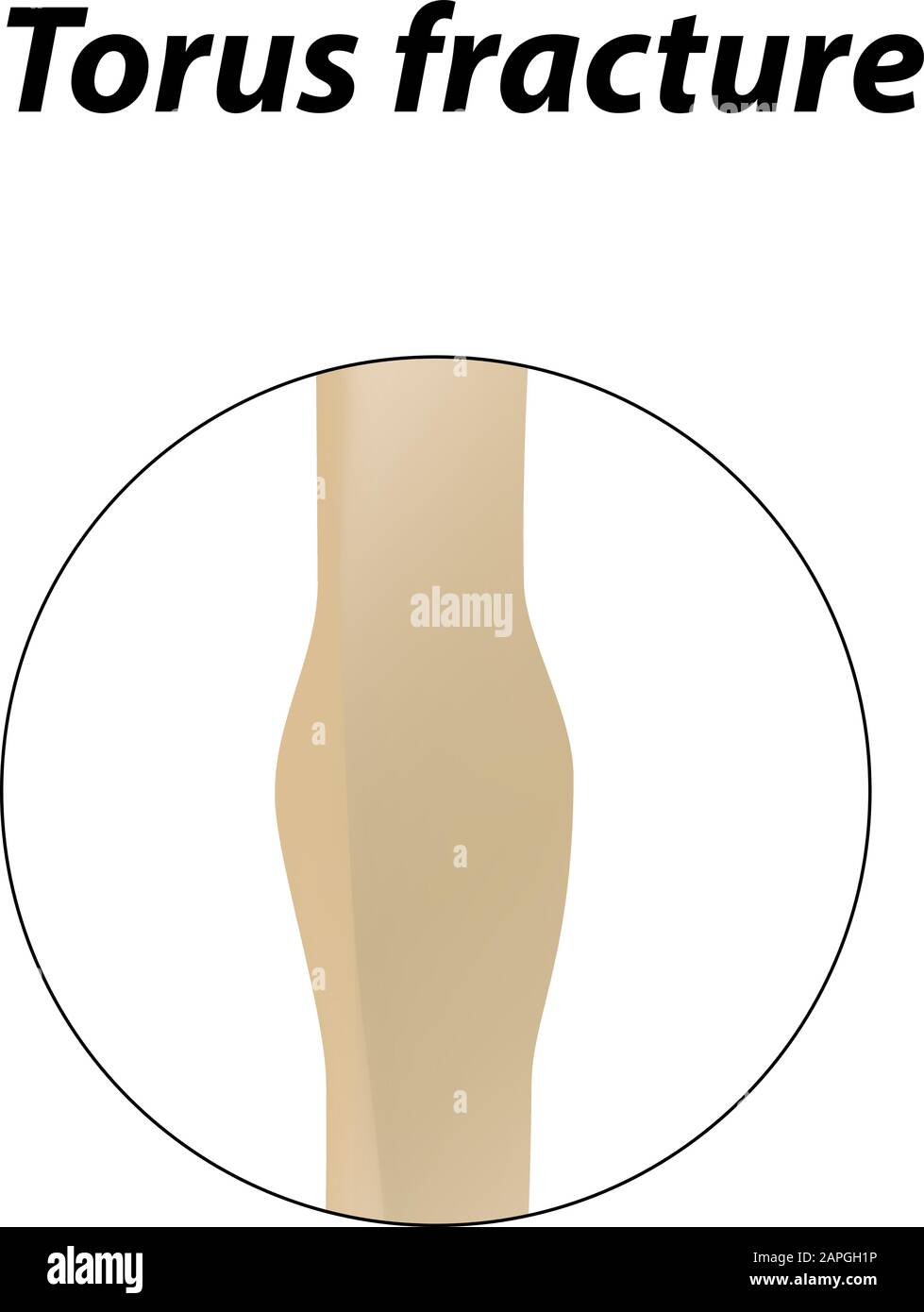Frattura ossea di Torus. Infografiche. Illustrazione vettoriale su uno sfondo allineato. Illustrazione Vettoriale