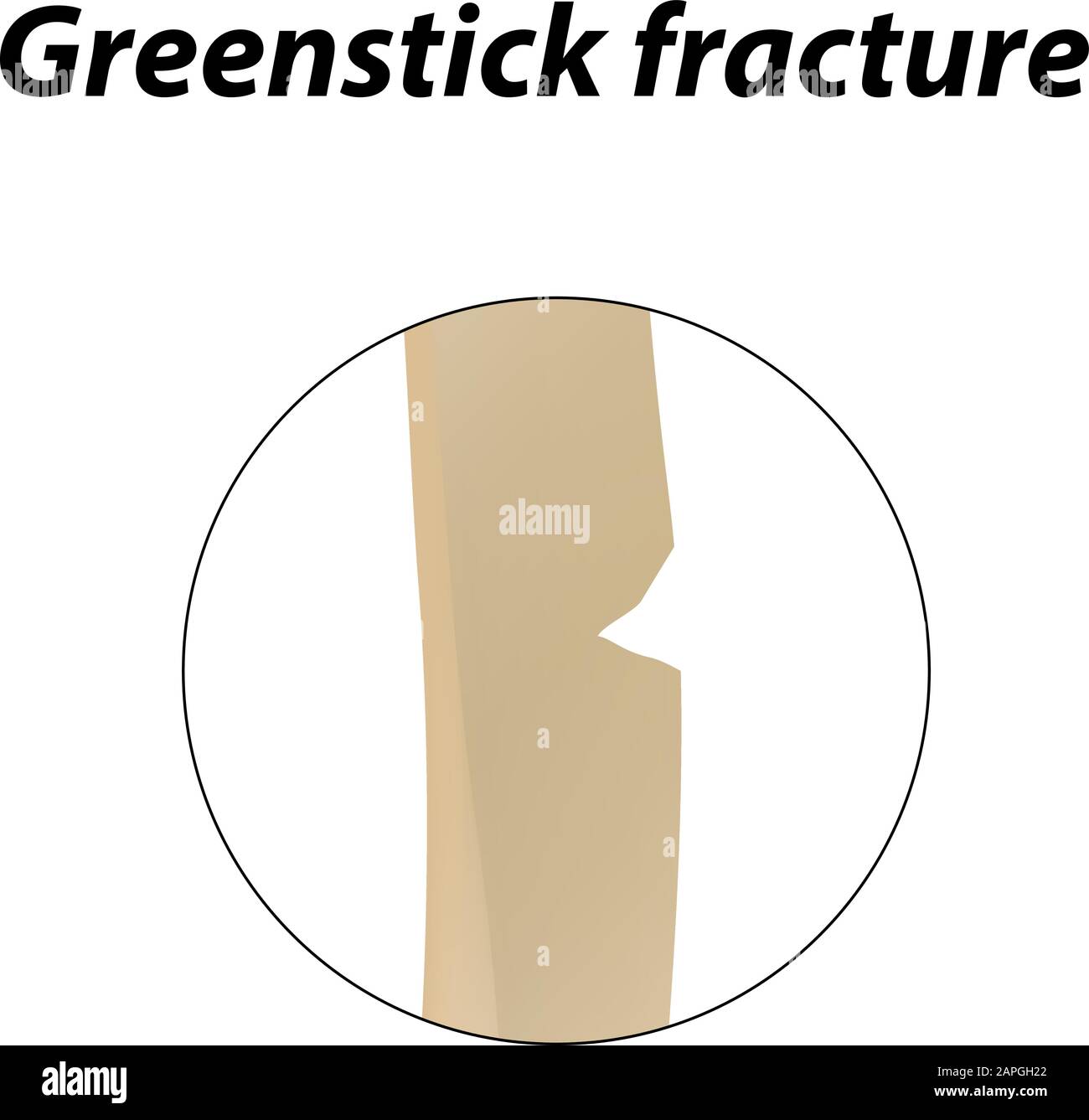 Frattura ossea Greenstick. Infografiche. Illustrazione vettoriale su uno sfondo allineato. Illustrazione Vettoriale