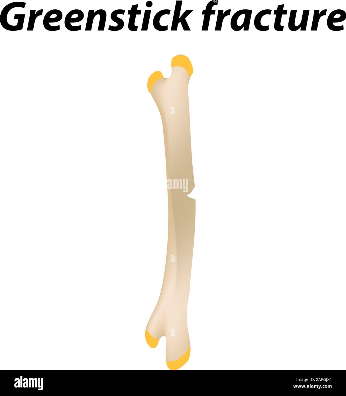 Frattura ossea Greenstick. Infografiche. Illustrazione vettoriale su uno sfondo allineato. Illustrazione Vettoriale