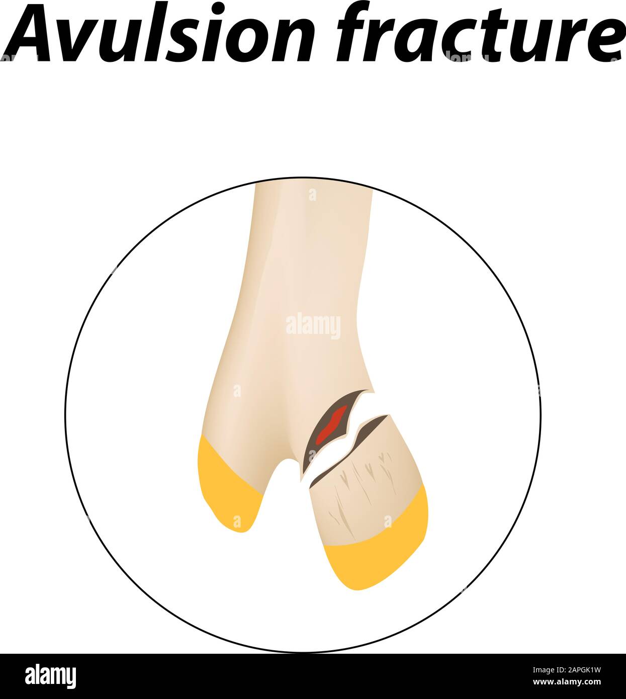 Frattura dell'Osso dell'avulsione. Infografiche. Illustrazione vettoriale su uno sfondo allineato. Illustrazione Vettoriale