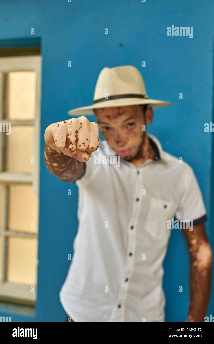 Ritratto di giovane uomo con vitiligo che indossa un cappello Foto Stock