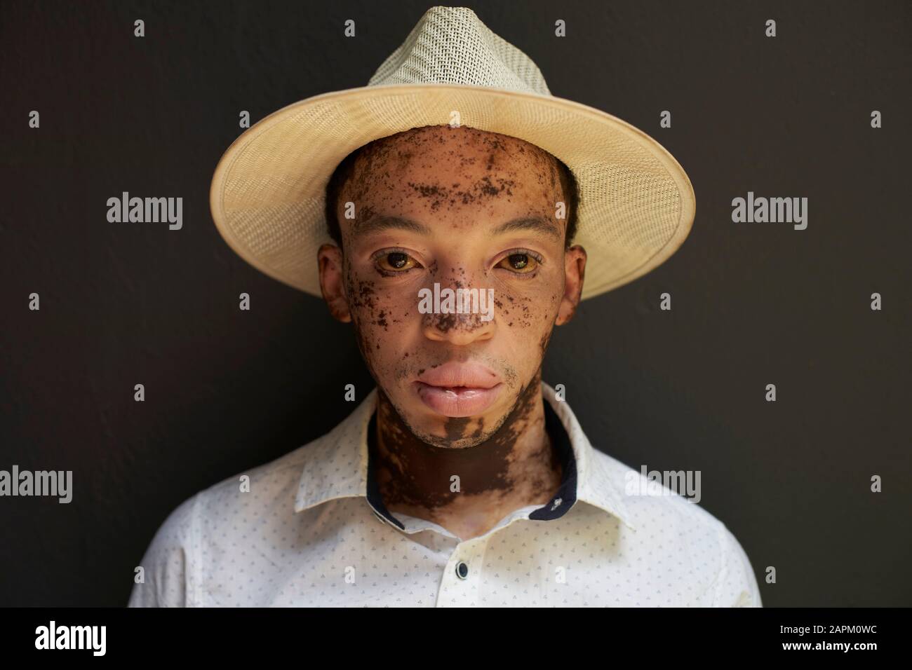 Ritratto di giovane uomo con vitiligo che indossa un cappello Foto Stock