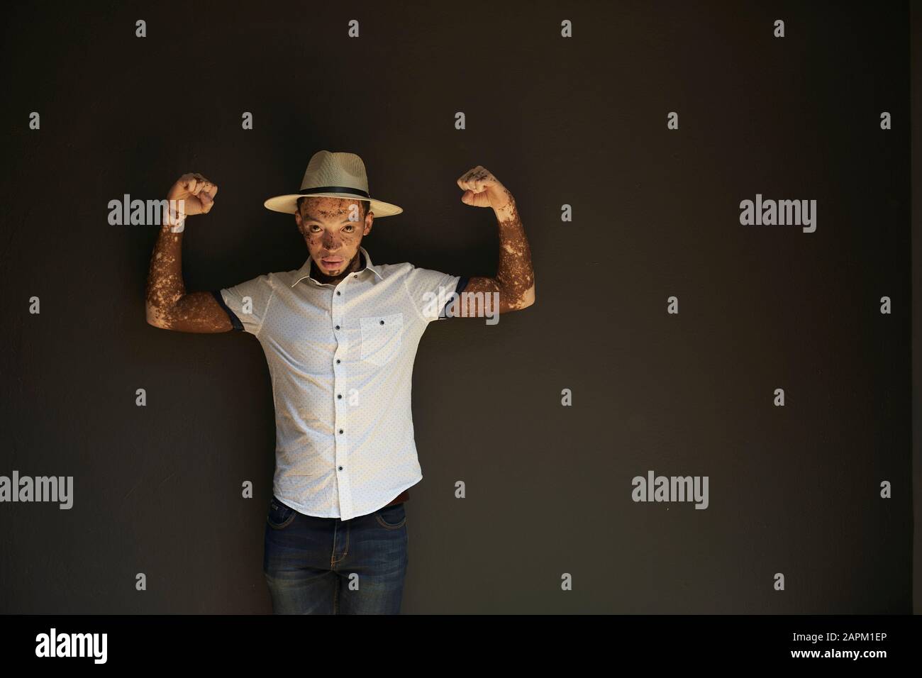 Ritratto di giovane uomo con vitiligo che indossa un cappello su una parete nera che mostra le sue braccia macchiate Foto Stock