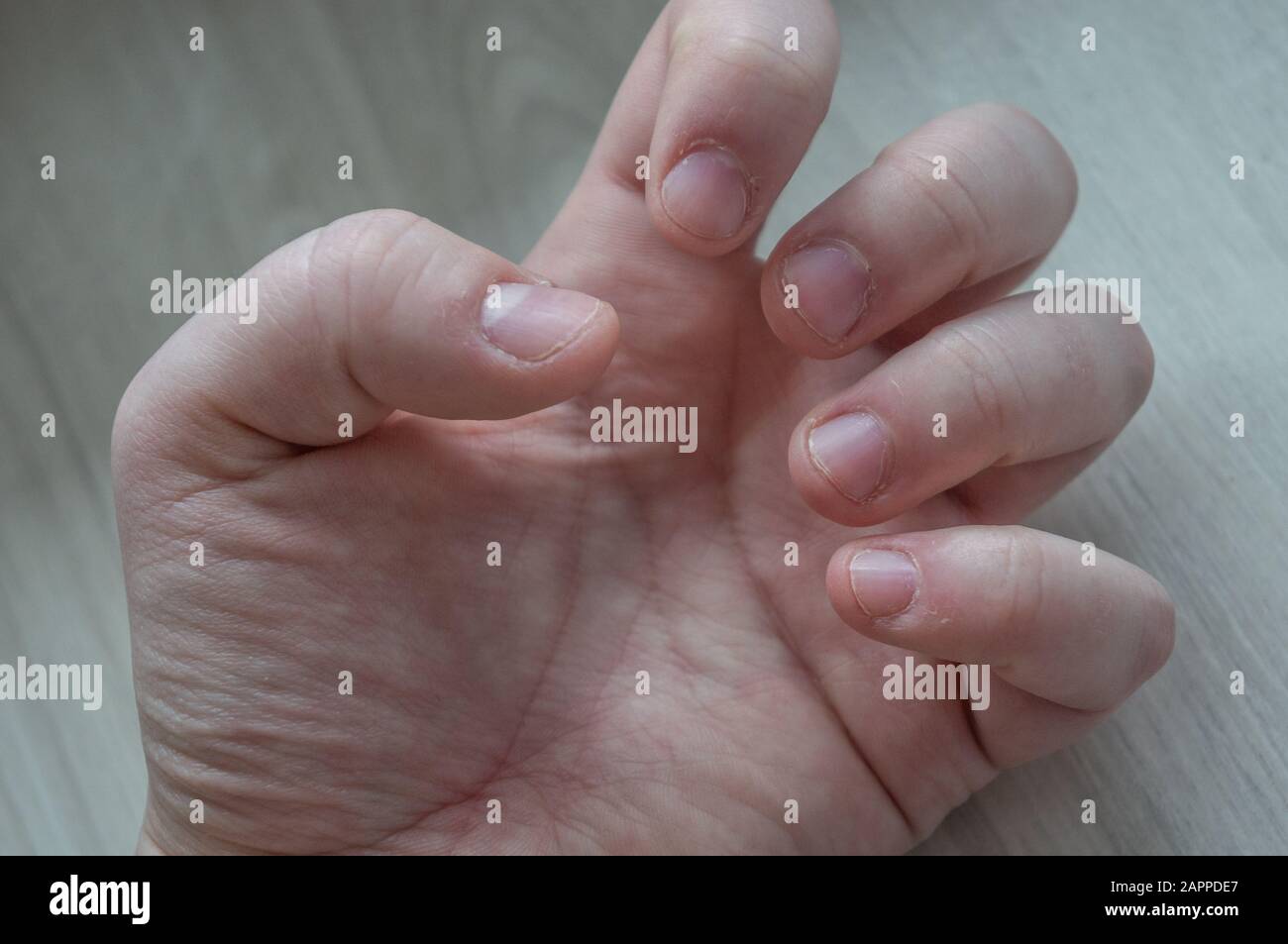 Unghie morse danneggiate a causa di disturbi d'ansia con cuticole  danneggiate dalla raccolta della pelle. Concettuale per stress, depressione  o scopi medici Foto stock - Alamy