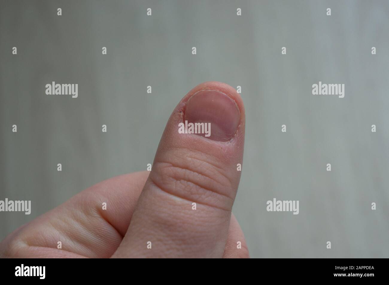 Miniatura morso danneggiata con cuticole e vesciche strappate. Condizione dovuta ad ossessivo, obbligatorio picking della pelle e mordente del chiodo. Concettuale dello stress, un Foto Stock