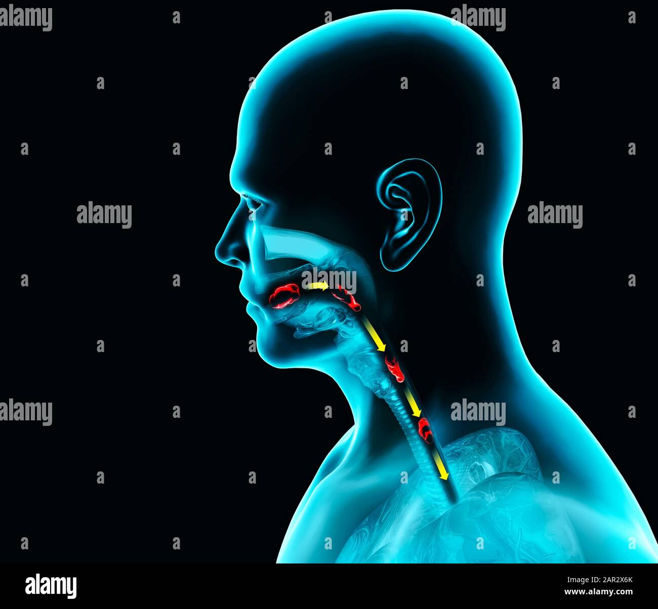 Ernia esofagea immagini e fotografie stock ad alta risoluzione - Alamy