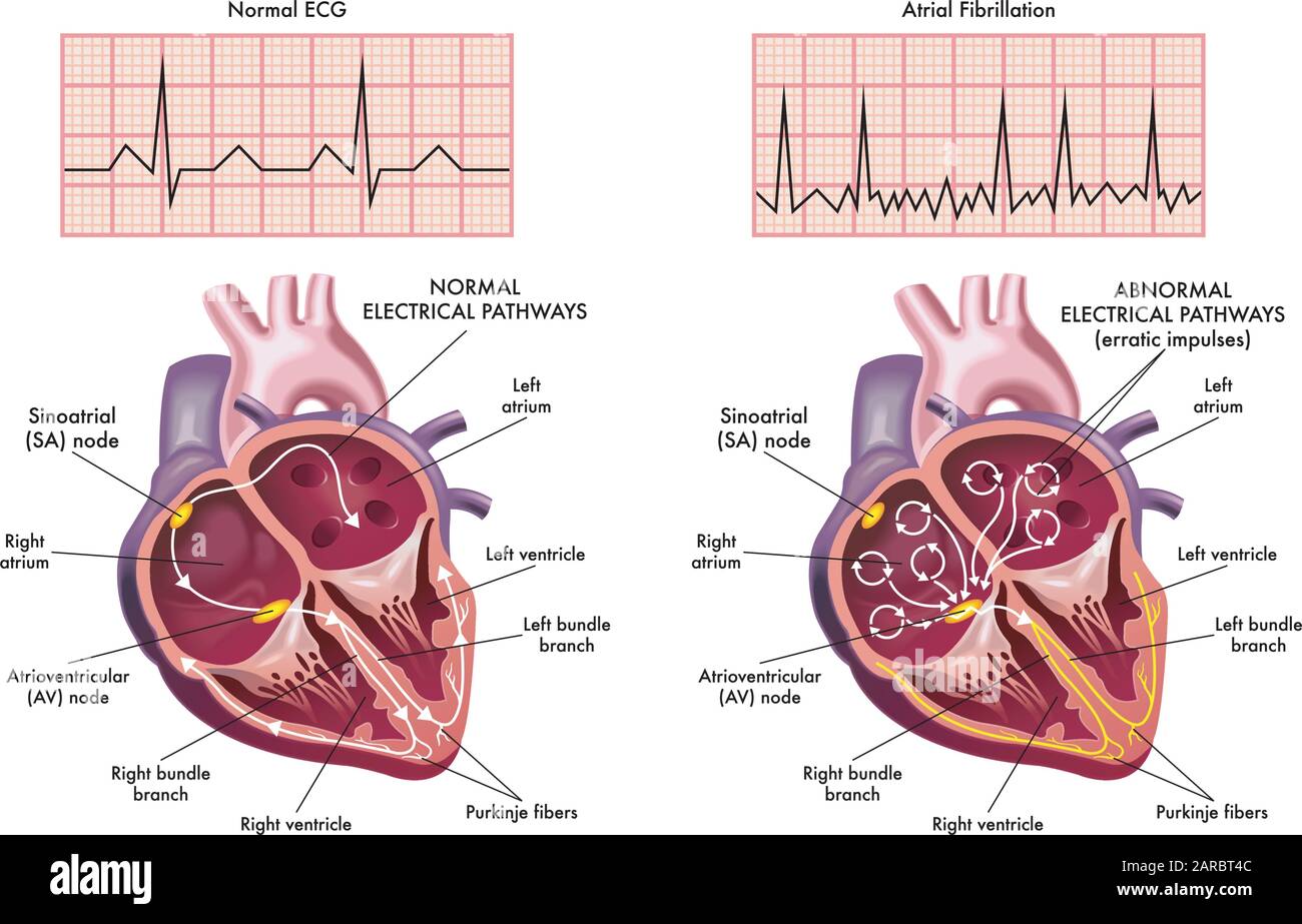Illustrazione medica che mostra i sintomi di un cuore con fibrillazione atriale rispetto a quello normale. Illustrazione Vettoriale