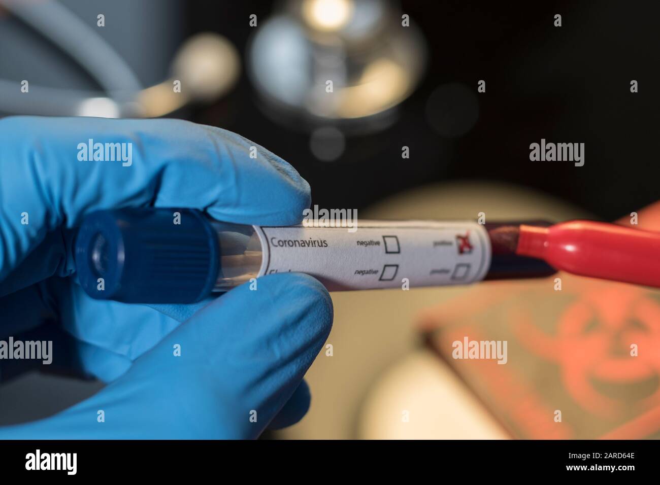 Test ematico positivo per il coronavirus di Wuhan. Primo piano del flaconcino di test del sangue positivo per il virus influenzale. Medici screening malati per virus e dis Foto Stock